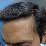 how to stop male pattern baldness naturally