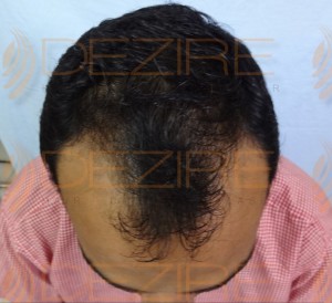 is hair transplant effective in india