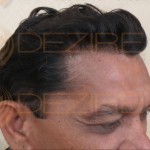 is hair transplant painful