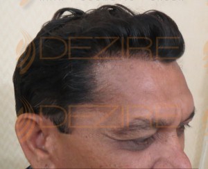 is hair transplant painful