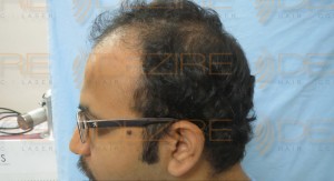 is hair transplant permanent