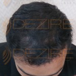 is hair transplant permanent solution