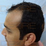 is hair transplant really effective