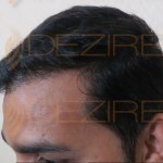 is hair transplant really permanent