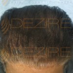 is hair transplant successful in india