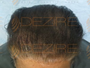 is hair transplant successful in india