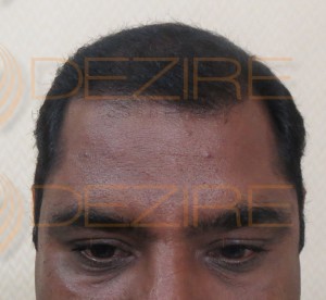 is prp necessary after hair transplant