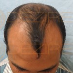 latest hair transplant techniques in india