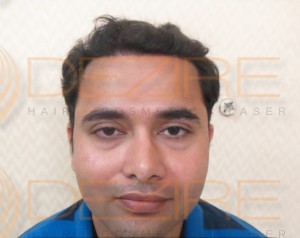 male hair transplant cost