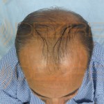 men's hair replacement systems