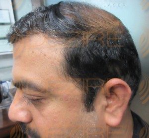 most advanced hair transplant technique