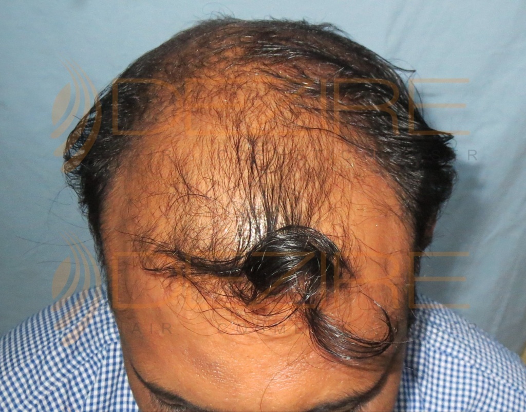 natural hair websites – Hair Transplant Pune