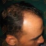 new hair transplant techniques in india
