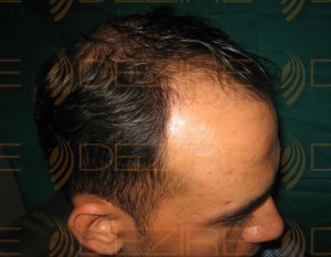 new hair transplant techniques in india