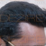 non surgical hair replacement