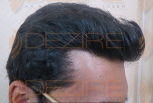non surgical hair replacement