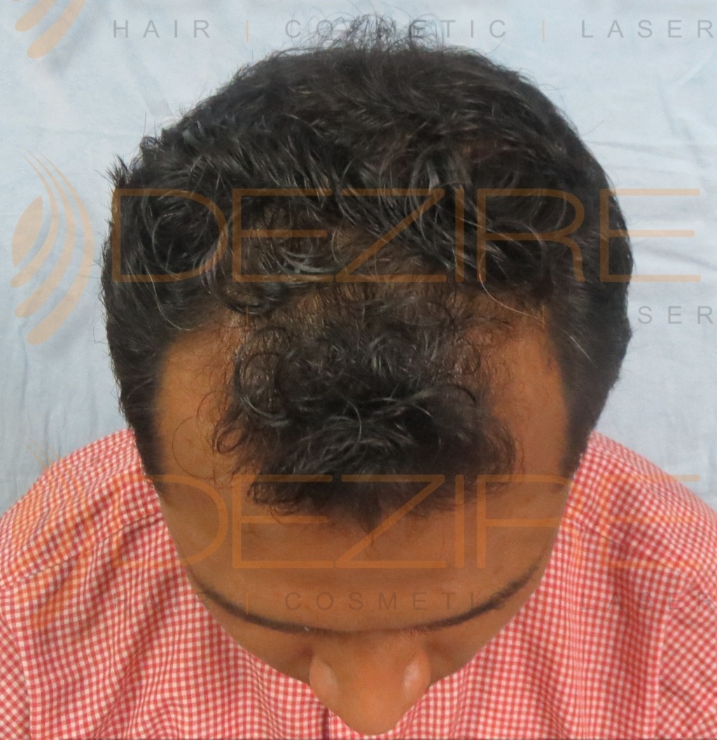 non surgical hair replacement benefits – Hair Transplant Pune