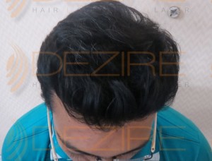 non surgical hair replacement cost in India