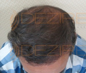 non surgical hair replacement cost in Pune