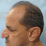 non surgical hair replacement cost in india