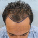 non surgical hair replacement maintenance