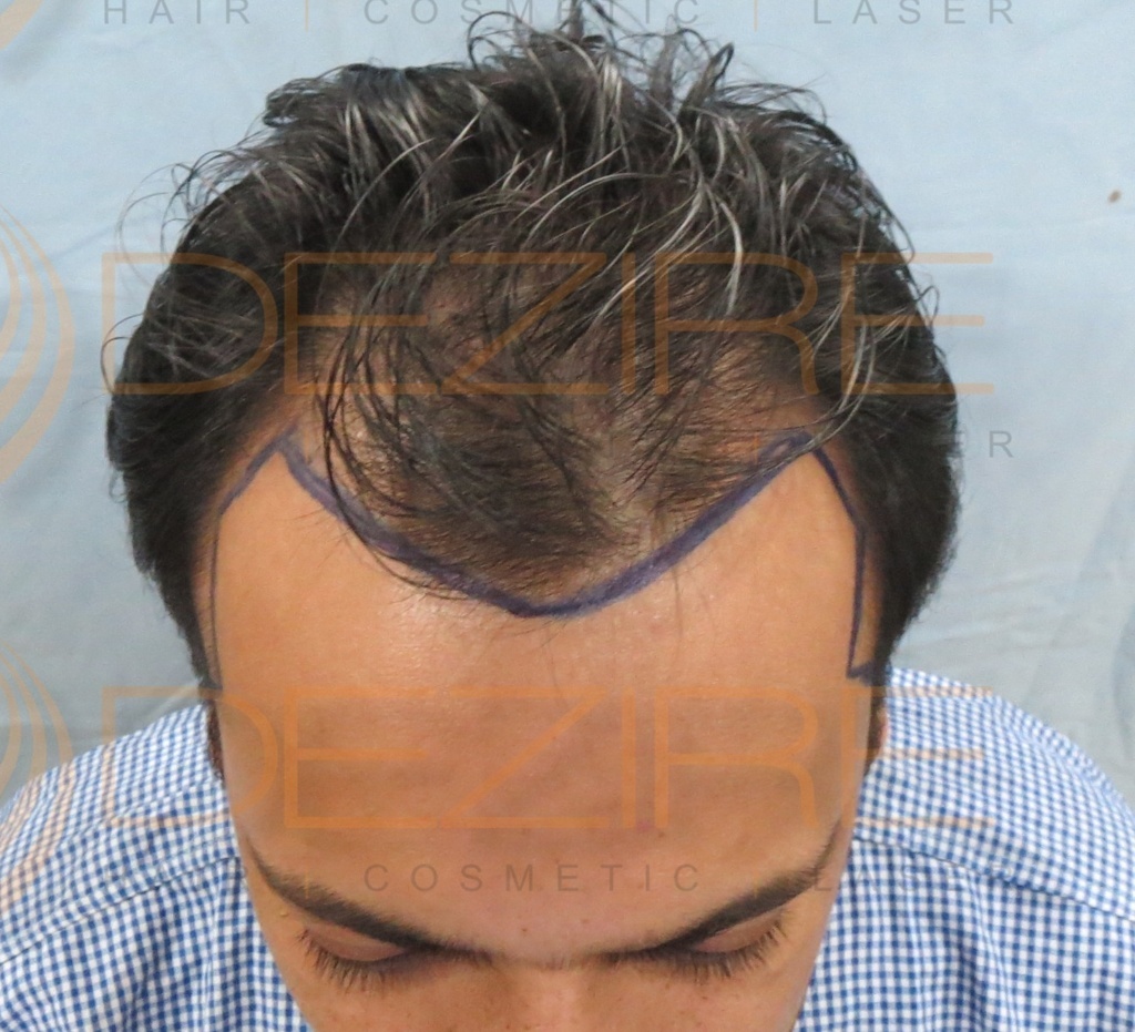 non surgical hair replacement maintenance – Hair Transplant Pune