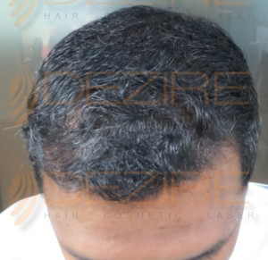 non surgical hair replacement maintenance