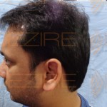 non surgical hair replacement systems