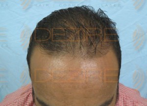 non surgical hair restoration options