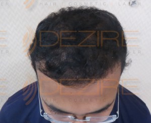 permanent hair replacement cost