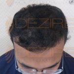 permanent hair replacement cost
