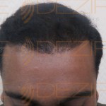 post hair transplant hair growth