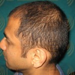 prp during hair transplant