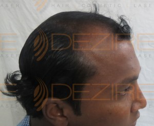 prp for hair loss cost