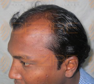 prp hair treatment cost in india