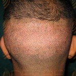 prp hair treatment cost in pune