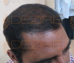 prp treatment for hair loss wiki