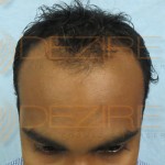 receding hairline natural treatment