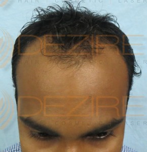 receding hairline natural treatment