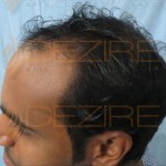 receding hairline stages
