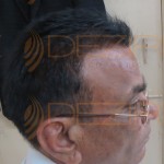 robotic hair transplant cost in india