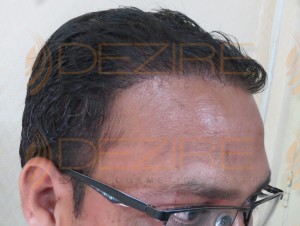 scalp pain after hair transplant