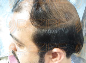 stem cell therapy for hair loss reviews