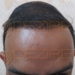sudden bald spot on side of head