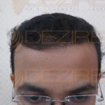 truth about hair transplant