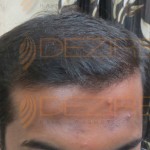 types of hair transplant in india