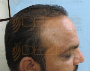 types of non surgical hair replacement