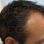 what are hair transplant doctors called