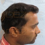 what to expect after hair transplant