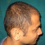 which is better prp or hair transplant